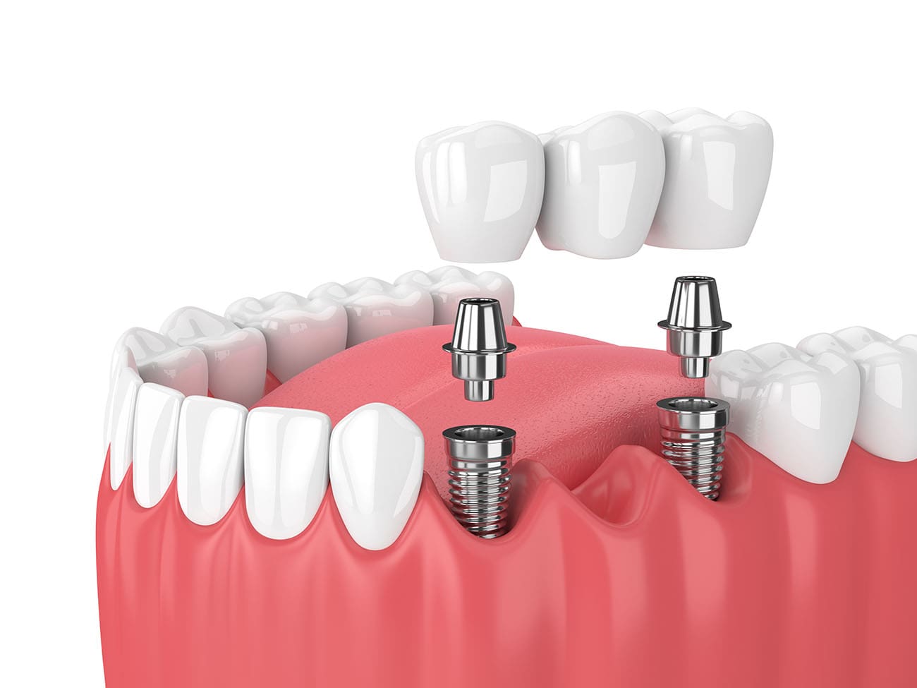 Unlike dentures or bridges, dental implants provide a permanent solution. However, not everyone qualifies for this advanced dental procedure.